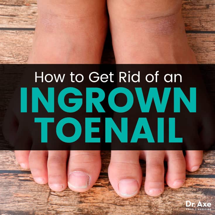 How to get rid of an ingrown toenail - Dr. Axe